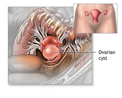 imagini chisturi ovariene